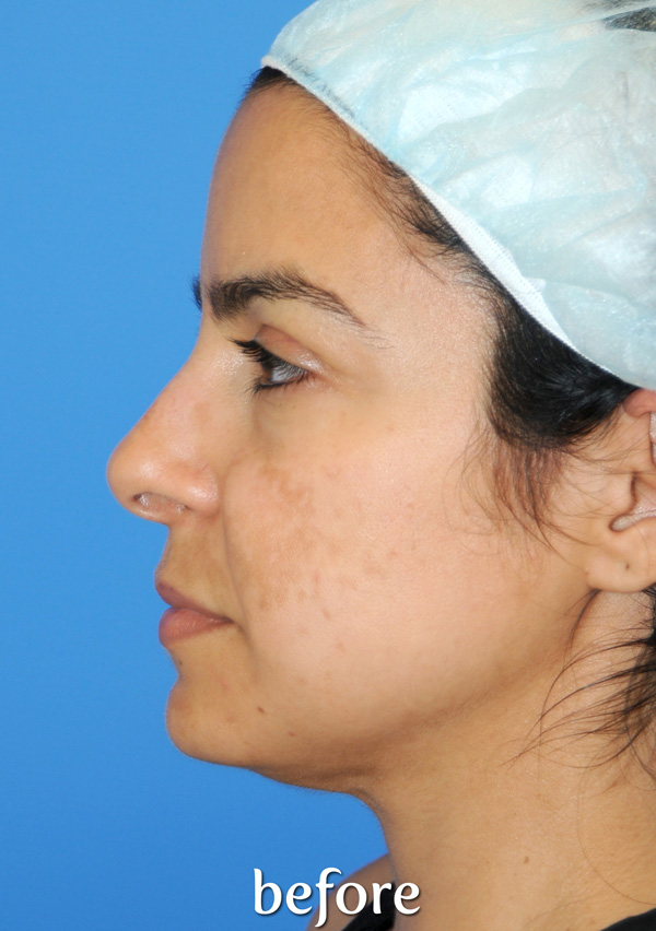 Y Lift Before & After Patient #4619