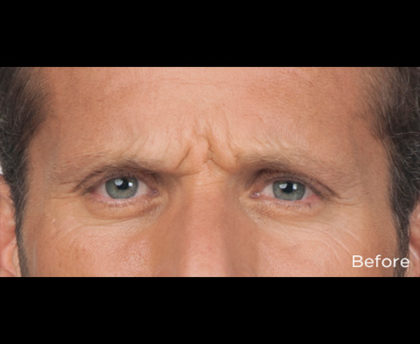 Botox Before & After Patient #4316