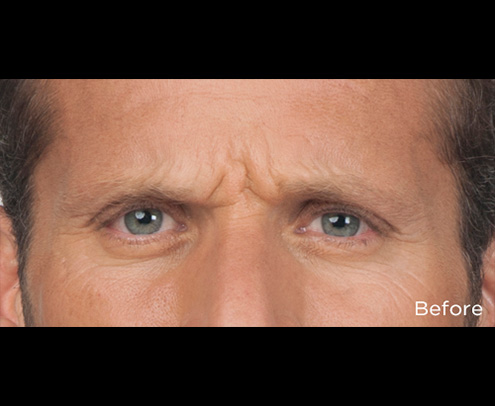 Botox Before & After Patient #4316