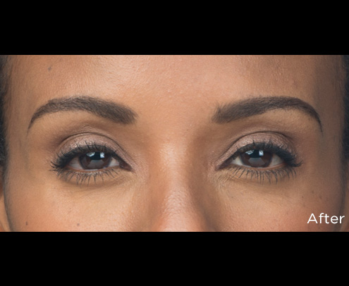 Botox Before & After Patient #4319