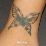 PicoSure Tattoo Removal Before & After Patient #4523