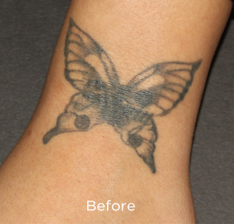 PicoSure Tattoo Removal Before & After Patient #4523