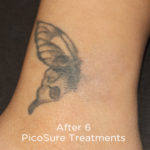 PicoSure Tattoo Removal Before & After Patient #4523