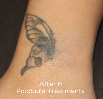 PicoSure Tattoo Removal Before & After Patient #4523