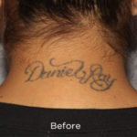 PicoSure Tattoo Removal Before & After Patient #4527