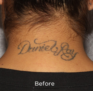 PicoSure Tattoo Removal Before & After Patient #4527