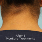 PicoSure Tattoo Removal Before & After Patient #4527