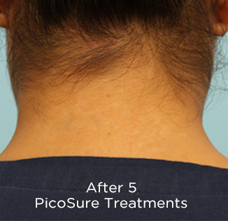 PicoSure Tattoo Removal Before & After Patient #4527