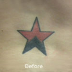 PicoSure Tattoo Removal Before & After Patient #4528