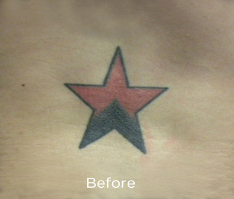 PicoSure Tattoo Removal Before & After Patient #4528