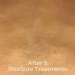 PicoSure Tattoo Removal Before & After Patient #4528