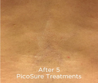 PicoSure Tattoo Removal Before & After Patient #4528