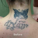 PicoSure Tattoo Removal Before & After Patient #4535