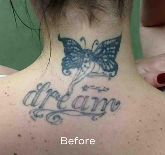 PicoSure Tattoo Removal Before & After Patient #4535