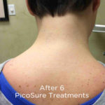 PicoSure Tattoo Removal Before & After Patient #4535