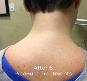 PicoSure Tattoo Removal Before & After Patient #4535