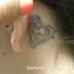 PicoSure Tattoo Removal Before & After Patient #4536