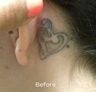 PicoSure Tattoo Removal Before & After Patient #4536