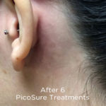PicoSure Tattoo Removal Before & After Patient #4536