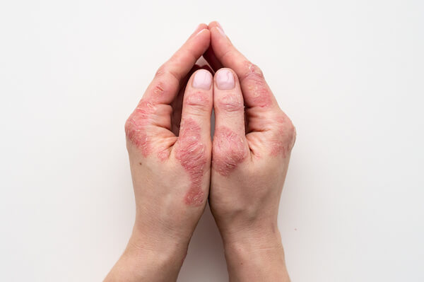Psoriasis treatment. Phoenix Skin.