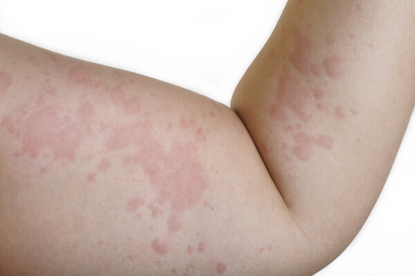 Itchy Skin Rash Dermatology Treatment