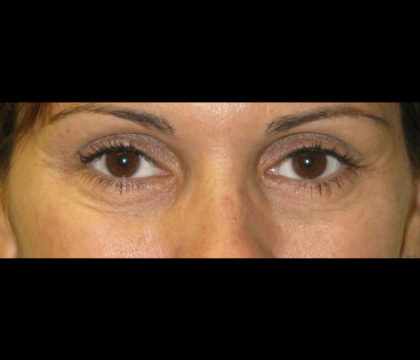 Restylane Before & After Patient #4554