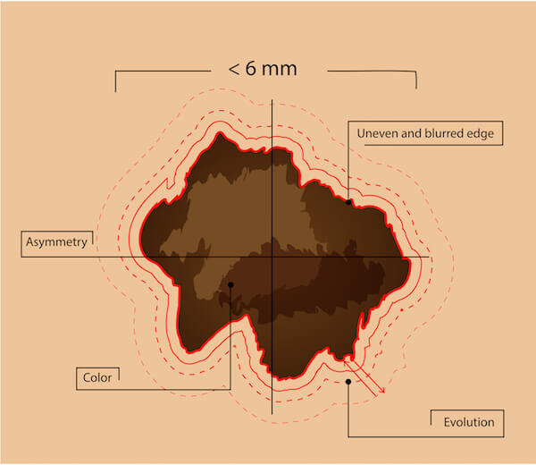 skin cancer procedure