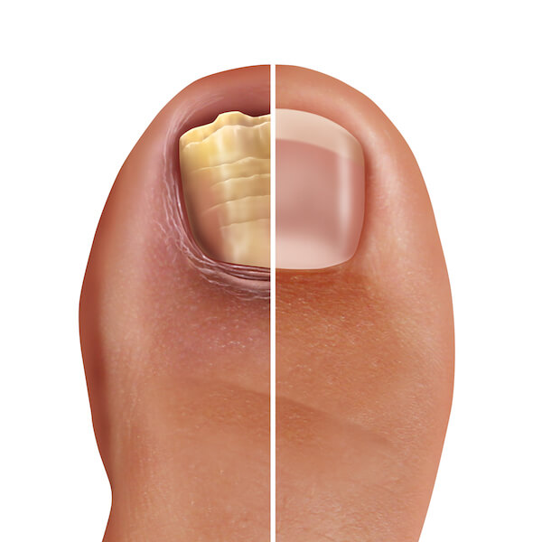 Toenail Fungus - Onychomycosis or tinea unguium - OC Foot and Ankle Clinic
