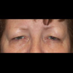 Blepharoplasty Before & After Patient #4307