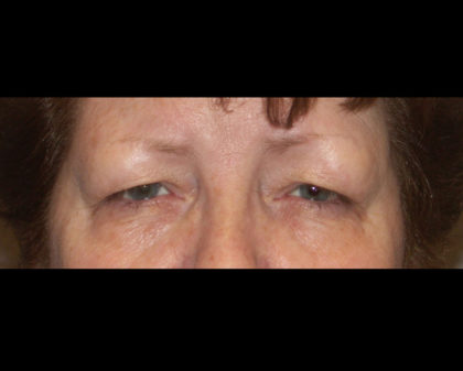 Blepharoplasty Before & After Patient #4307