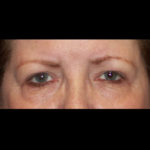 Blepharoplasty Before & After Patient #4307