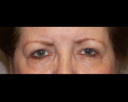 Blepharoplasty Before & After Patient #4307