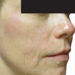 Venus Viva Before & After Patient #4597