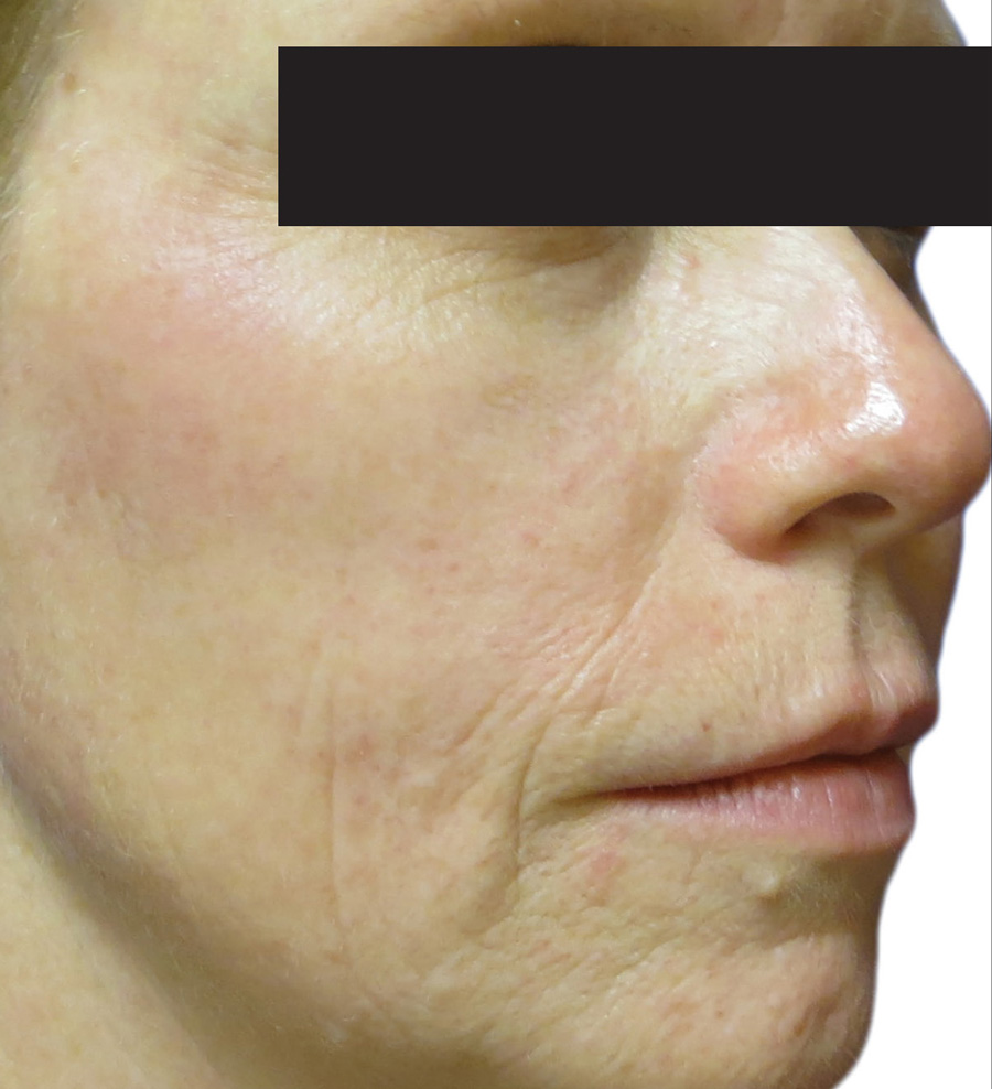 Venus Viva Before & After Patient #4597
