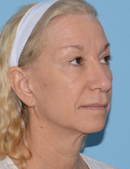 Juvederm Voluma Before & After Patient #4400