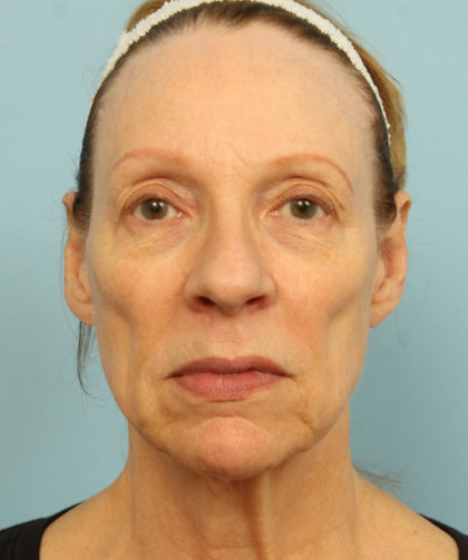 Juvederm Voluma Before & After Patient #4406