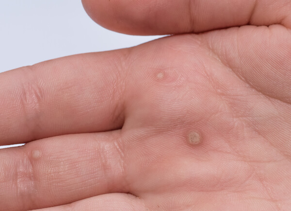 hpv skin warts treatment