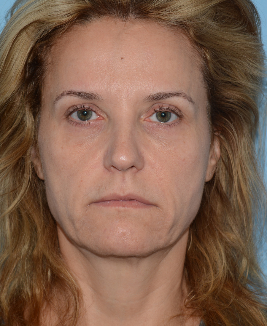 Y Lift Before & After Patient #4643