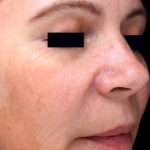 PicoSure Focus Before & After Patient #4515