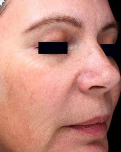 PicoSure Focus Before & After Patient #4515