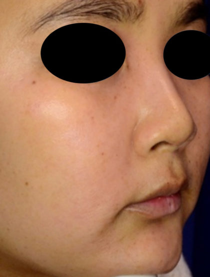 PicoSure Focus Before & After Patient #4522