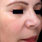 PicoSure Focus Before & After Patient #4515