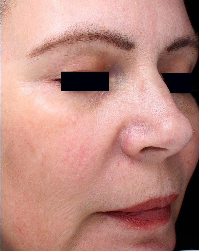PicoSure Focus Before & After Patient #4515