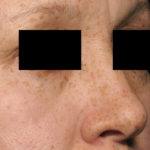 PicoSure Focus Before & After Patient #4514
