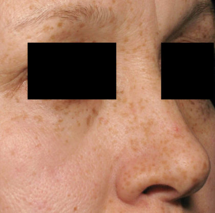 PicoSure Focus Before & After Patient #4514