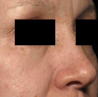PicoSure Focus Before & After Patient #4514