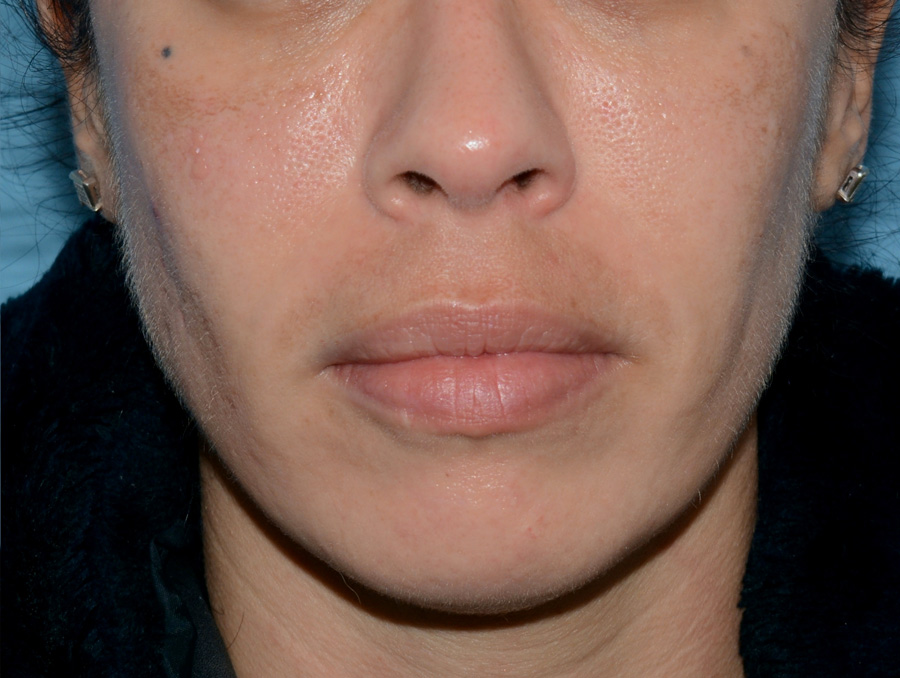 Red & Blue Light Therapy Before & After Patient #4277