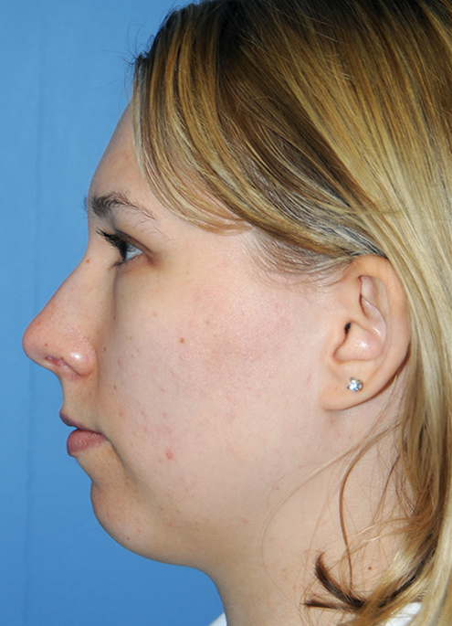 Y Lift Before & After Patient #4989
