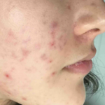 Acne Treatment Before & After Patient #5006