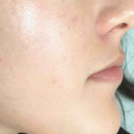 Acne Treatment Before & After Patient #5006